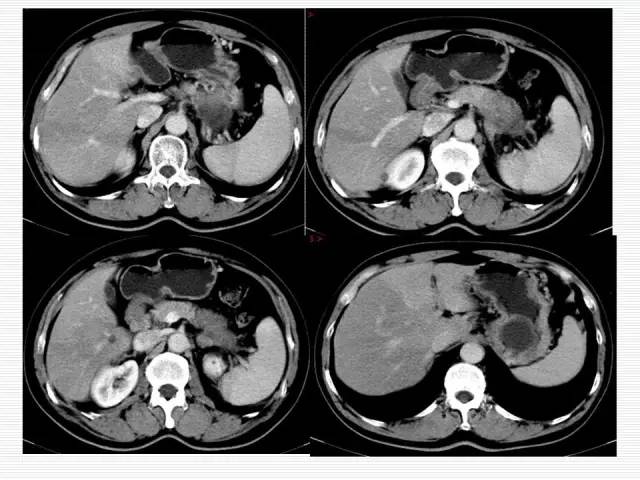 【病例】胰腺囊性病变6例CT影像表现与鉴别