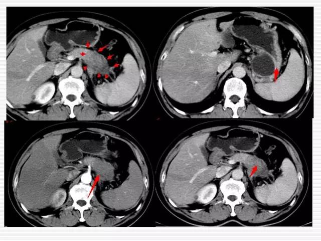 【病例】胰腺囊性病变6例CT影像表现与鉴别