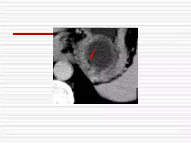 【病例】胰腺囊性病变6例CT影像表现与鉴别
