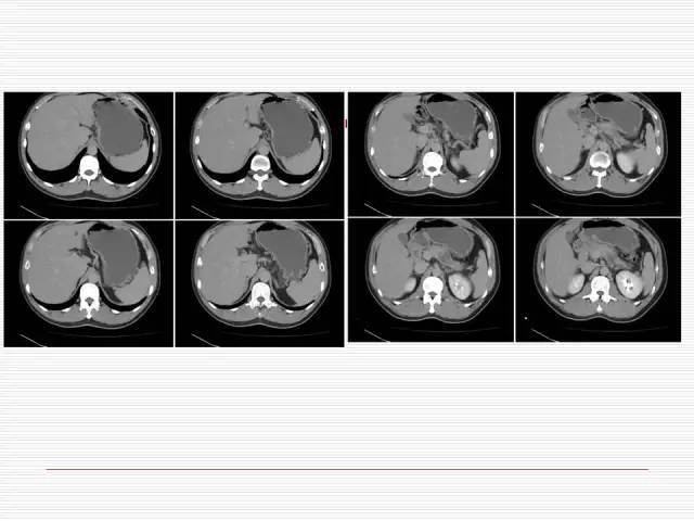 【病例】胰腺囊性病变6例CT影像表现与鉴别