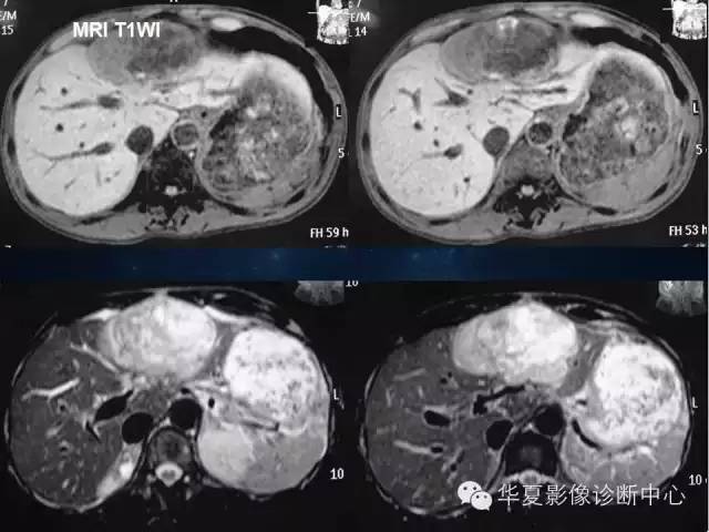 【病例】肝脏异位嗜铬细胞瘤1例影像表现
