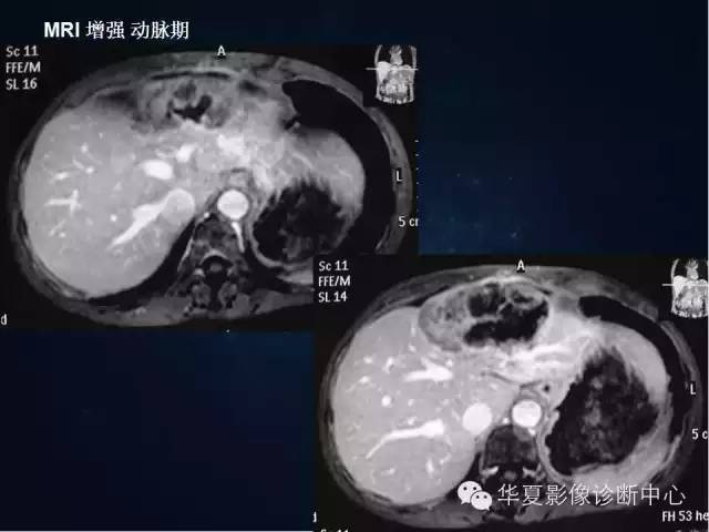 【病例】肝脏异位嗜铬细胞瘤1例影像表现