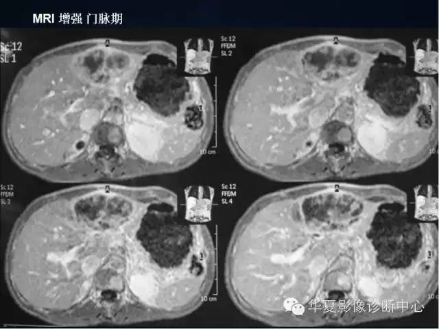 【病例】肝脏异位嗜铬细胞瘤1例影像表现