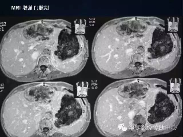 【病例】肝脏异位嗜铬细胞瘤1例影像表现