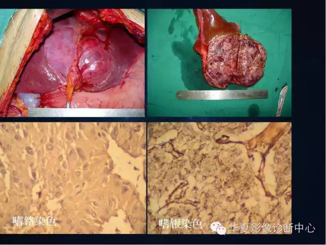 【病例】肝脏异位嗜铬细胞瘤1例影像表现
