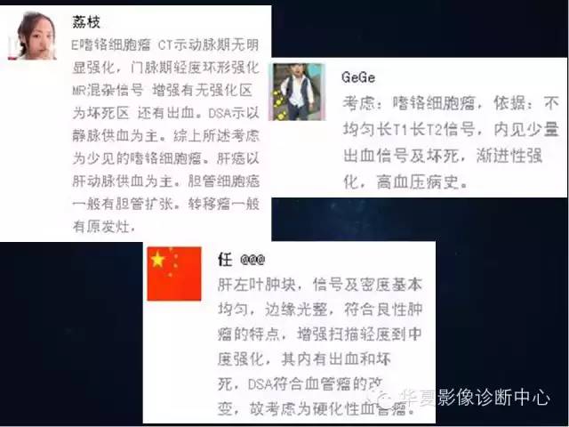 【病例】肝脏异位嗜铬细胞瘤1例影像表现