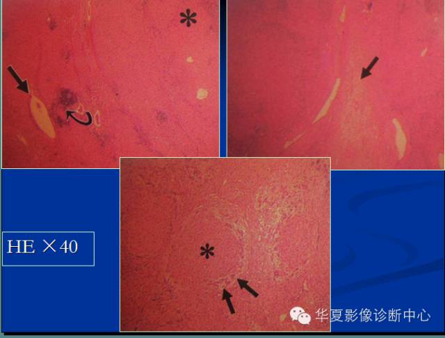 【PPT】局灶性结节增生的影像表现