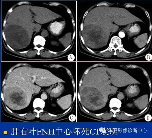 【PPT】局灶性结节增生的影像表现