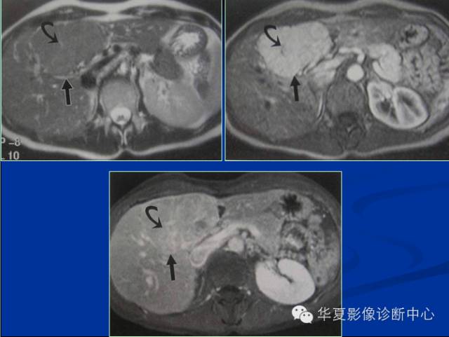【PPT】局灶性结节增生的影像表现