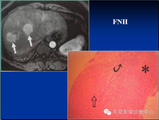 【PPT】局灶性结节增生的影像表现