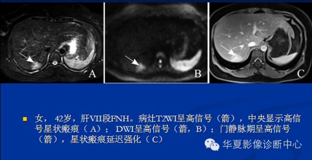 【PPT】局灶性结节增生的影像表现