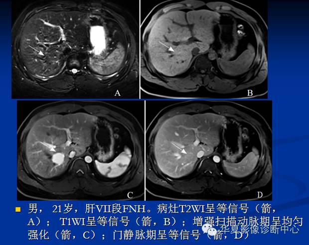 【PPT】局灶性结节增生的影像表现