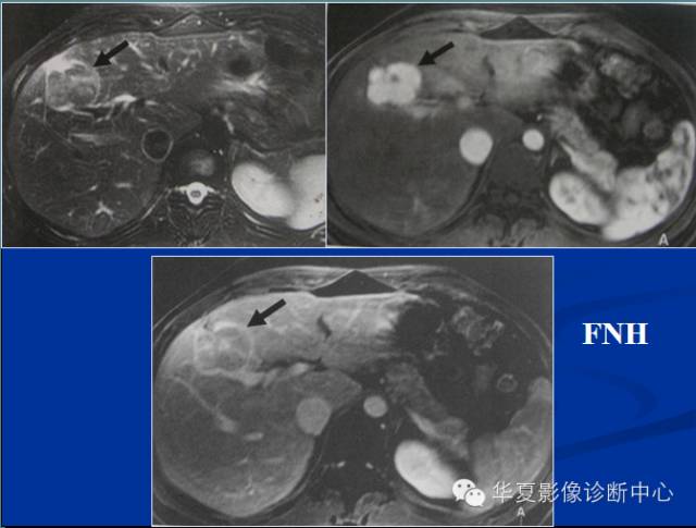 【PPT】局灶性结节增生的影像表现