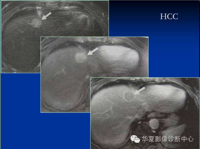 【PPT】局灶性结节增生的影像表现