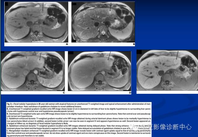 【PPT】局灶性结节增生的影像表现