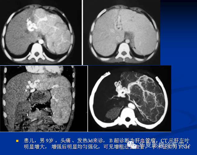 【PPT】局灶性结节增生的影像表现