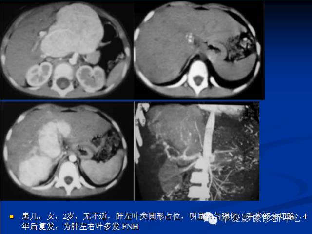 【PPT】局灶性结节增生的影像表现