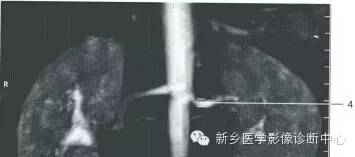 血管和MRCP一些正常影像数值