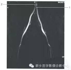 血管和MRCP一些正常影像数值