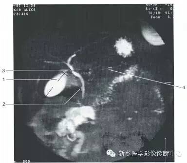 血管和MRCP一些正常影像数值