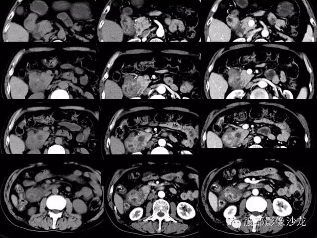 【病例】沟槽型胰腺炎1例影像表现