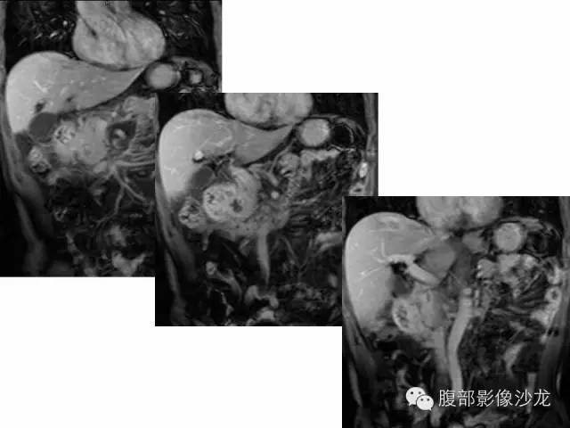 【病例】沟槽型胰腺炎1例影像表现