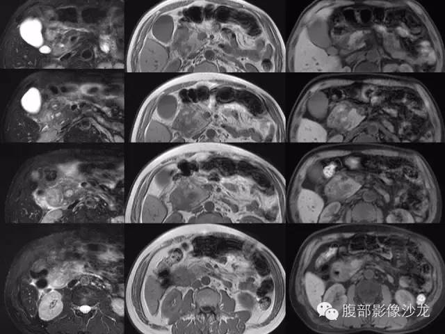 【病例】沟槽型胰腺炎1例影像表现