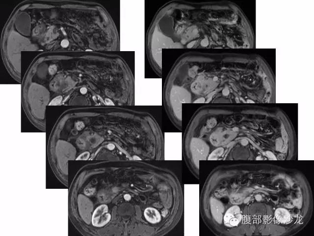 【病例】沟槽型胰腺炎1例影像表现