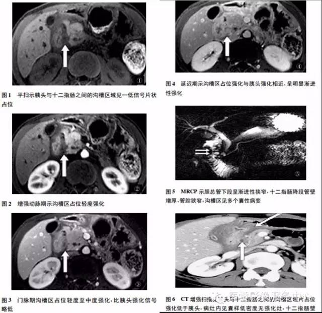 【病例】沟槽型胰腺炎1例影像表现