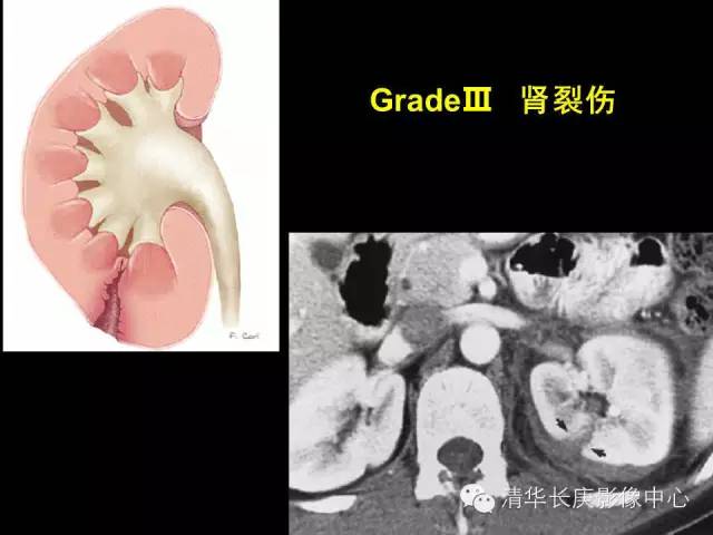 【病例】肾