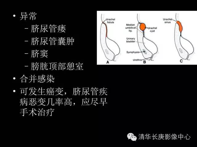 【病例】脐尿管脓肿1例影像表现