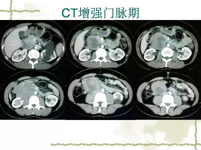 【病例】腹膜后平滑肌肉瘤1例CT影像表现