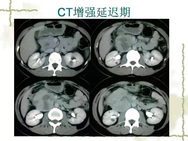 【病例】腹膜后平滑肌肉瘤1例CT影像表现