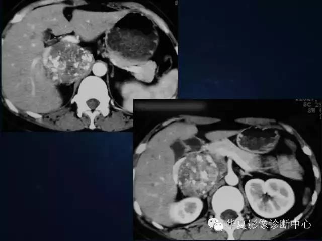【病例】腹膜后间叶性软骨肉瘤1例CT影像表现