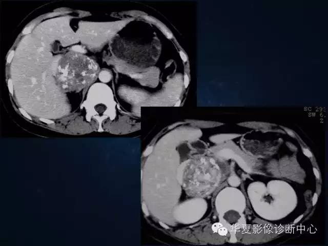 【病例】腹膜后间叶性软骨肉瘤1例CT影像表现