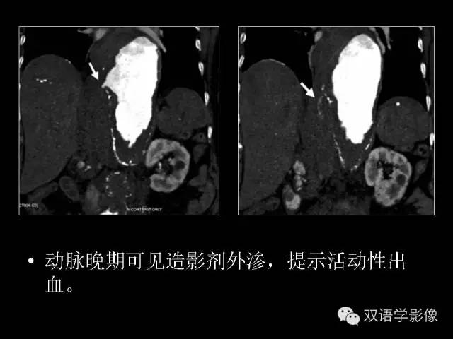 【PPT】MDCT评价腹主动脉瘤不稳定性