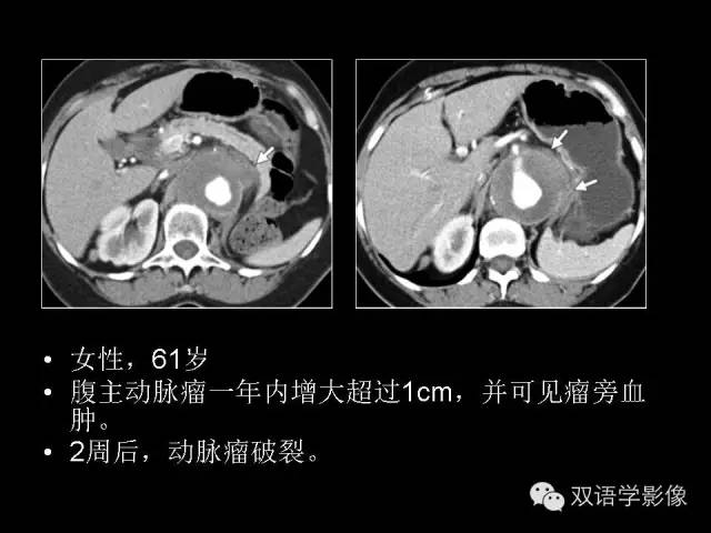 【PPT】MDCT评价腹主动脉瘤不稳定性