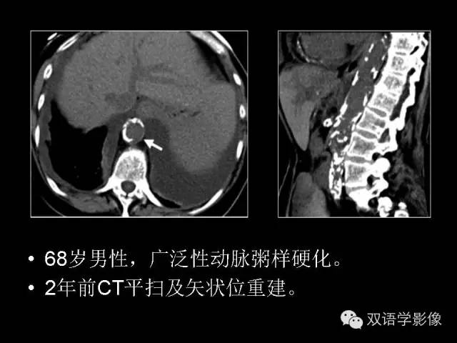 【PPT】MDCT评价腹主动脉瘤不稳定性