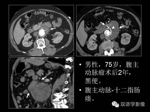 【PPT】MDCT评价腹主动脉瘤不稳定性
