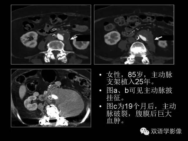 【PPT】MDCT评价腹主动脉瘤不稳定性