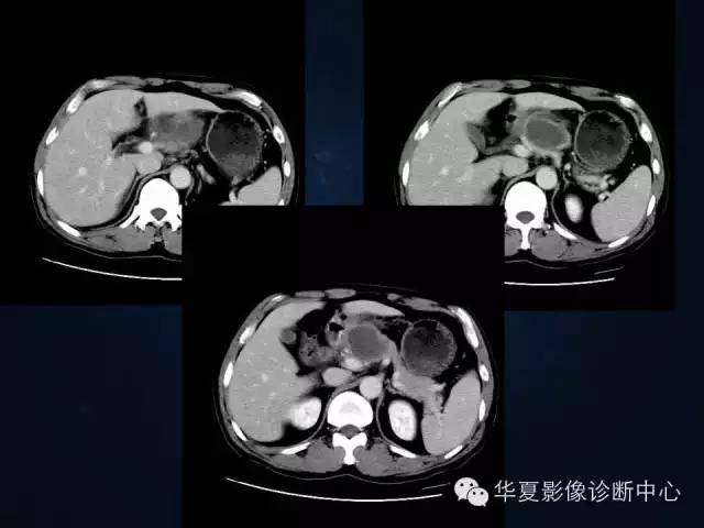 【病例】胰腺原发性恶性淋巴瘤1例CT影像表现与鉴别