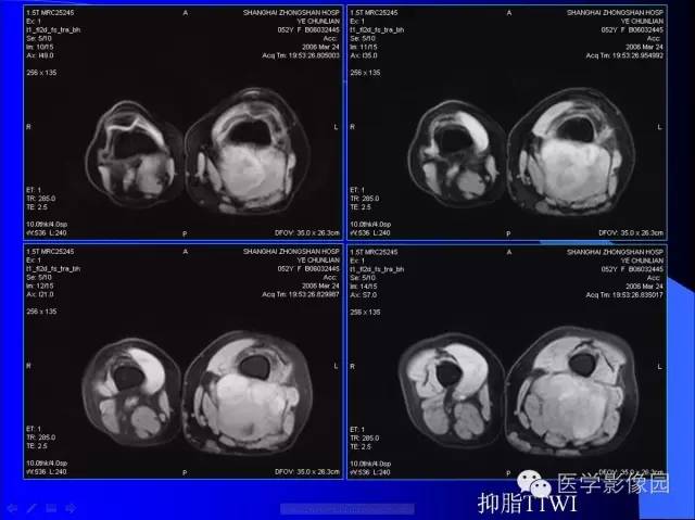 【病例】大腿恶性孤立性纤维瘤1例MR影像表现