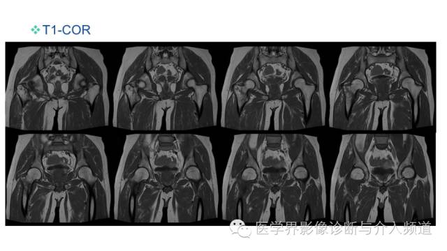 【病例】骨样骨瘤1例MR影像表现