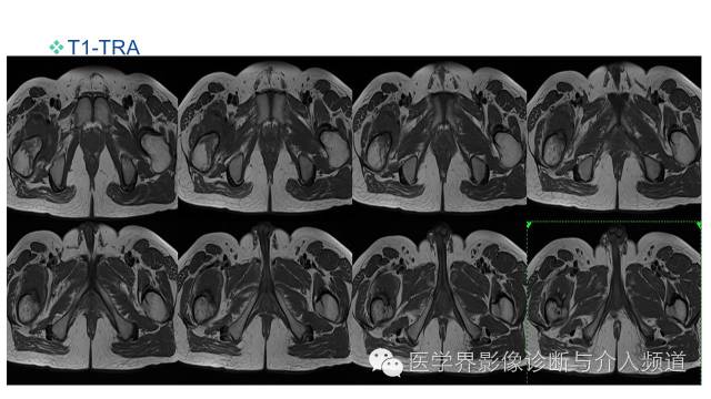 【病例】骨样骨瘤1例MR影像表现