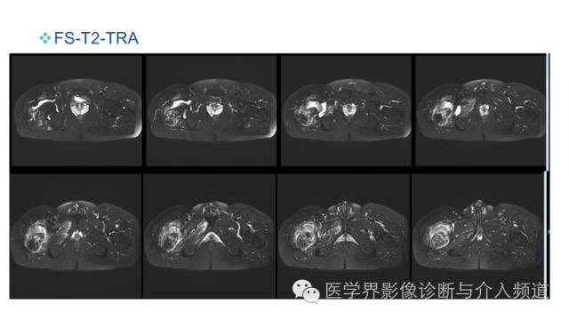 【病例】骨样骨瘤1例MR影像表现