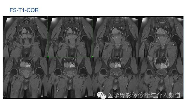 【病例】骨样骨瘤1例MR影像表现