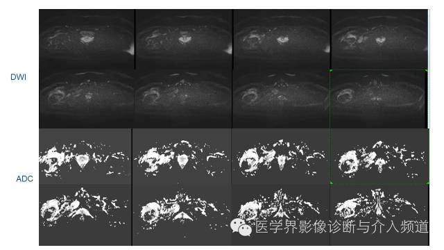【病例】骨样骨瘤1例MR影像表现