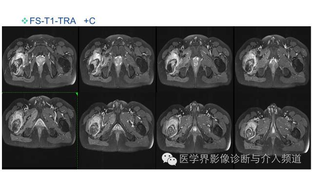 【病例】骨样骨瘤1例MR影像表现