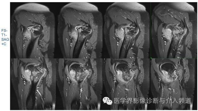 【病例】骨样骨瘤1例MR影像表现