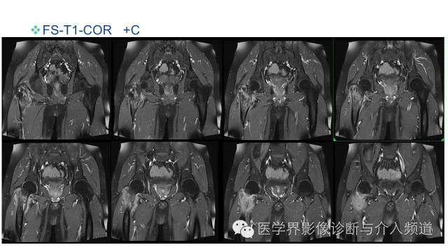 【病例】骨样骨瘤1例MR影像表现